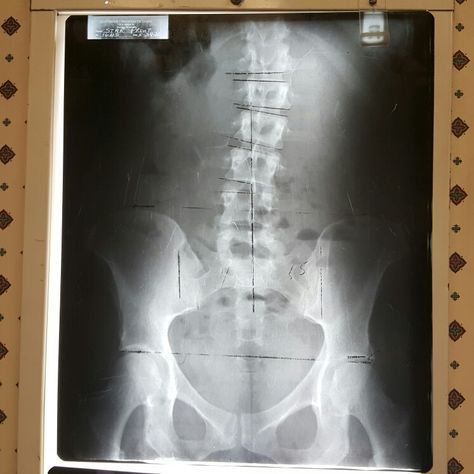 This is the lumbar scoliosis in my spine (these are my xrays) Orthopedic Aesthetic, Spine Xray, Chronic Pain, Lumber, Surgery, Abstract Artwork, Health, Quick Saves