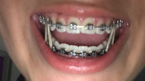 Teeth With Braces, Black Braces, Cute Braces Colors, Teeth Aesthetic, Pretty Teeth, Adult Braces, Glossy Lips Makeup, Braces Tips, Getting Braces