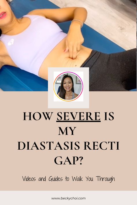 Checking the gap of diastasis recti, or the separation between the abdominal muscles, is an important step in understanding and addressing this condition. Self-checking should be done gently and cautiously to avoid causing discomfort or worsening the condition. #selfcheck #diastasisrecti #abdominalseparation #healthandwellness #fitness #postpartum Fitness Postpartum, Diastasis Recti Repair, What Is Diastasis Recti, Mommy Belly, Stomach Muscles, Diastasis Recti, Tummy Tucks, Abdominal Muscles, The Gap