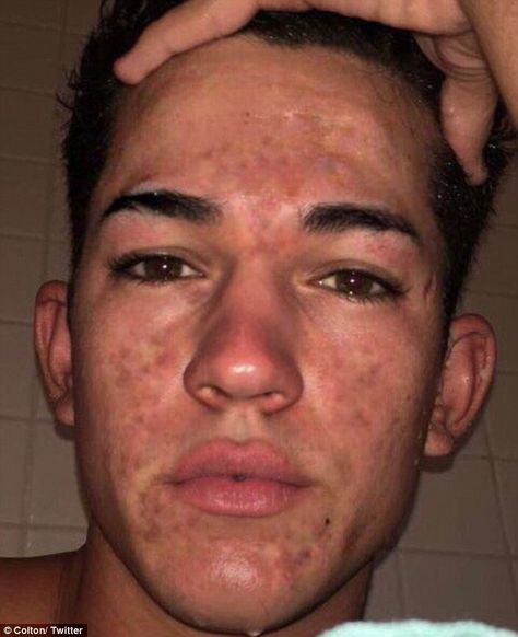 Acne: A 19-year-old boy (pictured in September 2017) from Los Angeles who suffered from cystic acne cleared his skin in just five months using a simple five-step natural routine Bad Skin Pictures, Guys With Acne, Acne Positive, Acne Positivity, Acne Men, Pimples On Forehead, Back Acne Remedies, Bad Skin, Forehead Acne