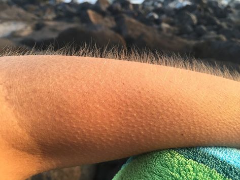 Getting to the bottom of goosebumps. The post Scientists discovered the real reason behind goosebumps appeared first on Tech Explorist Human Body Facts, Human Body Parts, Dating Divas, Thyroid Gland, Stem Cells, Hair Follicle, Health Problems, Listening To Music, Real People