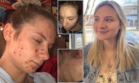 Young woman spent years hiding face after 'daily skin picking sessions' | Daily Mail Online Face Picking Disorder, How To Stop Picking Your Face, How To Stop Skin Picking, Picking Disorder, Skin Picking Disorder, Skin Picking, Columbia South Carolina, Hiding Face, Time Pictures