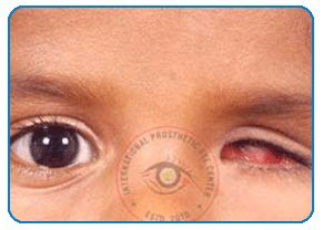 congenital anophthalmia microphthalmia, international prosthetic eye center Glass Eye Prosthetic, Ocular Prosthesis, Prosthetic Eye, Prosthetic Device, Anatomy References, Medical Profession, Eye Problems, Eye Center, Oc Inspiration