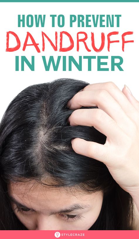 How To Prevent Dandruff, How To Remove Dandruff, Prevent Dandruff, How To Treat Dandruff, Dandruff Solutions, Dandruff Remedy, Getting Rid Of Dandruff, Diy Hair Masks, Winter Air