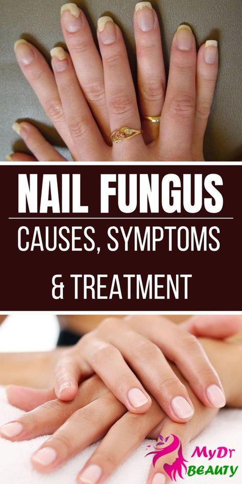 Healthy Nail Polish, Nail Remedies, Fingernail Fungus, Toenail Fungus Remedies, Girly Tingz, Nail Fungus Remedy, Nail Infection, Fungal Nail, Finger Nails