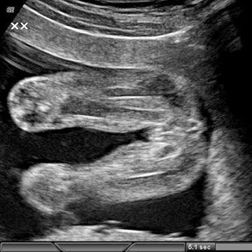 18 Week Ultrasound: Female Gender Reveal Ultrasound Boy Or Girl, Ultrasound Pictures Gender, 15 Week Ultrasound, Boy Ultrasound Pictures, Baby Gender Ultrasound, Fetal Development Week By Week, Ultrasound Gender Prediction, Boy Ultrasound, 12 Week Ultrasound