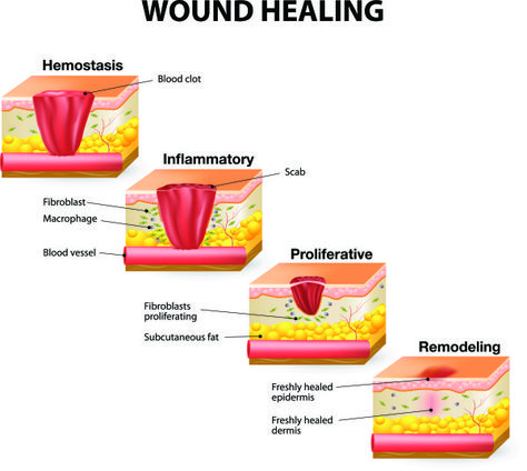 Healing Illustration, Stages Of Healing, Wound Care Nursing, Integumentary System, Nursing School Notes, Nursing Tips, White Blood Cells, Wound Care, Body Healing