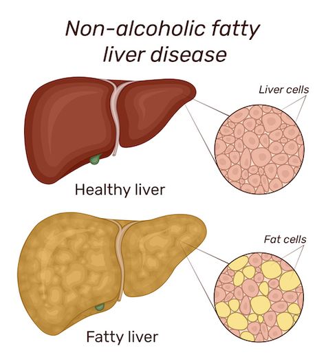 Are you at risk for fatty liver disease? - Women's Health Network Gallbladder Stones, Tuna Patties, Robotic Surgery, Liver Failure, Feminine Health, Beef Liver, Protein Powders, Kidney Health, Healthy Liver