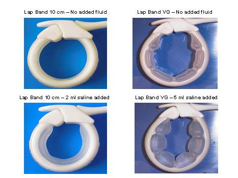 http://www.nationalbariatriclink.org/lap-band-slippage.html Lap Band, Gastric Band, Led Band, Post Op, One Pound, For Your Eyes Only, Paleo Diet, The Band, Fat Loss