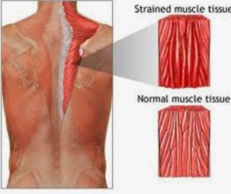 a SWOLE 'nother level: Dealing with DOMS! Muscle Fiber, Cupping Therapy, Muscle Strain, Muscle Spasms, Body Pain, Muscle Tissue, Physical Wellness, Back Muscles, Muscle Pain