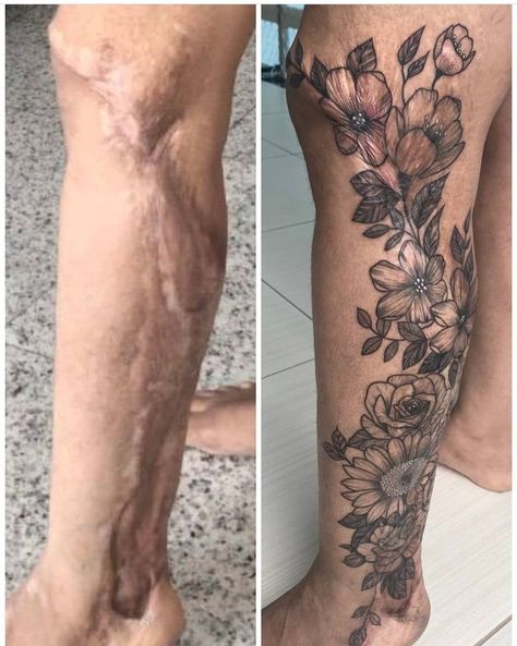 Shin Scar Tattoo Cover Up, Scare Tattoo Cover Ups, Keloids Tattoo Cover Up, Surgical Scar Tattoo, Arm Tattoos To Cover Scars, Stretch Mark Tattoo, Scars Tattoo, Tattoo Over Scar, Scar Cover Up