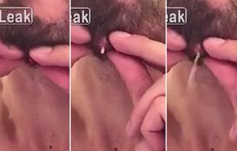 Man Pops a Pimple On His Chin That’s So Big and Leaky, He Almost Pukes Chin Acne Remedies, Chin Acne Causes, Big Zits, Nose Pimples, Pimples On Buttocks, Big Pimple, Pimples On Forehead, Chin Acne, Blind Pimple