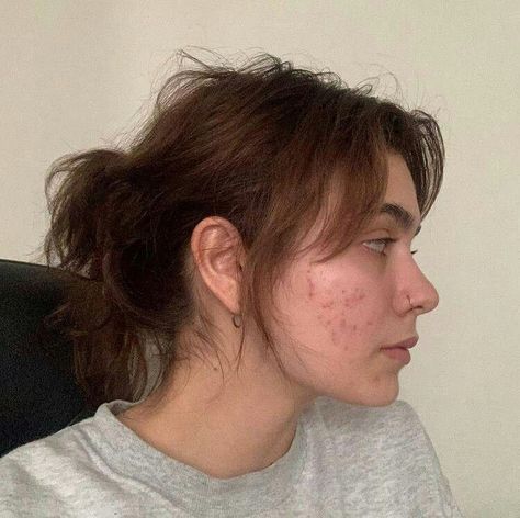 Girl With Acne Aesthetic, Imperfect Skin, Girl With Acne, Acne Positivity, Faces Of People, Acne Beauty, The Moment You Realize, Real Skin, No Wrinkles