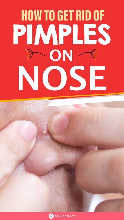 Acne On Nose, Zit Remedy, Nose Pimples, Big Pimple, Home Remedies For Pimples, Blind Pimple, Get Rid Of Pimples, Rid Of Pimples, Pimples Under The Skin