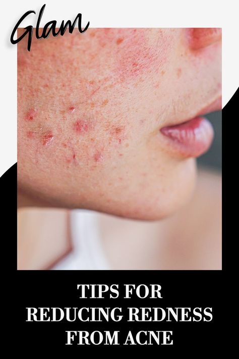 Acne Redness Reducing Skin Care, Reduce Redness In Face Acne, Red Marks On Skin, Skin Redness Remedies, Red Spots On Skin, Red Spots On Face, Reduce Acne Redness, Redness Remedy, Reduce Face Redness