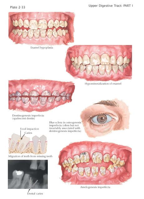 Dental Abnormalities   The teeth exhibit many structural abnormalities, which may occur as a result of developmental or genetic alteratio... Oral Pathology, Remedies For Tooth Ache, Dental World, Dentistry Student, Dental Anatomy, Dental Hygiene School, Restorative Dentistry, Loose Tooth, Dental Facts