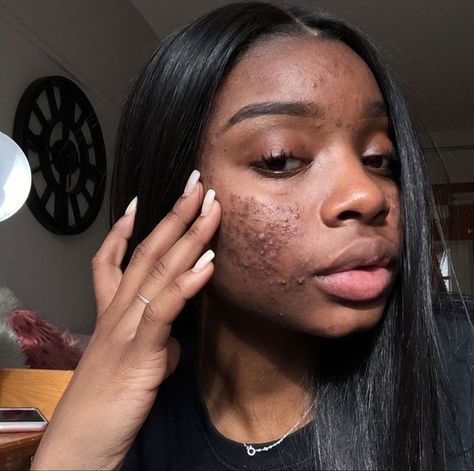 Girl With Acne, Shallow People, Black Skin Care, Brown Spots Removal, Dark Under Eye, Bare Beauty, Pretty Skin, Raw Beauty, Beauty Standards