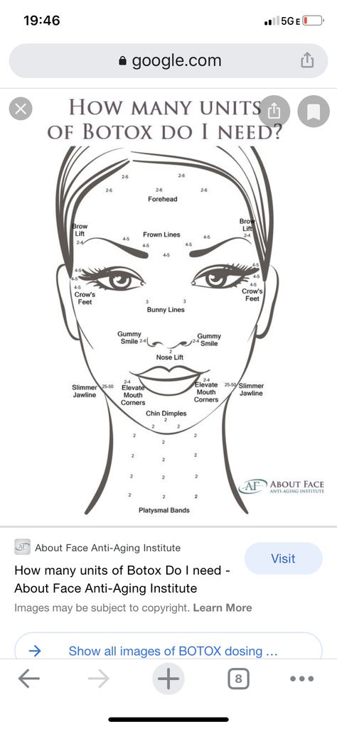 Botox Face Mapping, Botox Injection Sites Diagram, Botox Placement, Botox Mapping, Armonizacion Facial, Injection Room, Injection Image, Iv Nurse, Clinic Aesthetic