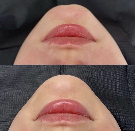 Ready for a Little Enhancement? Elevate your profile with a refined chin and sculpted confidence. How do you like this subtle transformation? 💖 ___________________ Amaks Aesthetics Med Spa 📍1934A Williamsbridge Rd, Bronx, NY For appointments or free consultations, DM or call 🌸 📲 (917) 701-0253 📞 (585)441-3838 #lipfillernewyork #lipfillersnewyork #lipfillernyc #lipinjectionsnyc #lipinjectionsnewyork #lipfillerbronx #lipfillersbronx #lipsinjectionnyc Chin Filler, Face Fillers, Facial Plastic, Lip Injections, Medical Aesthetic, Lip Fillers, Med Spa, Cosmetology, Plastic Surgery