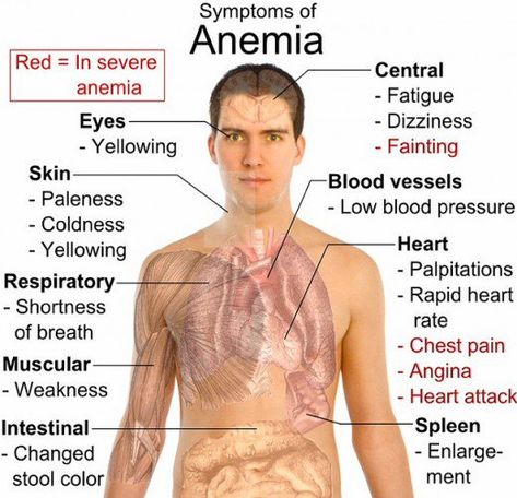 Common symptoms of anemia. Constantly Tired, Nursing Fun, Homeopathy Remedies, Angina Pectoris, B12 Deficiency, Iron Deficiency, Low Blood Pressure, Low Blood Sugar, V Video