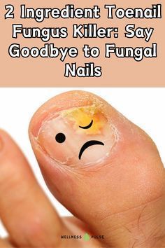 Fungal Nail Ugly Toenails, Toenail Fungal Infection, Toenail Fungus Remedies, Fungal Nail, Toenail Fungus, Fungal Infection, Nail Fungus, Strong Nails, Nail Health