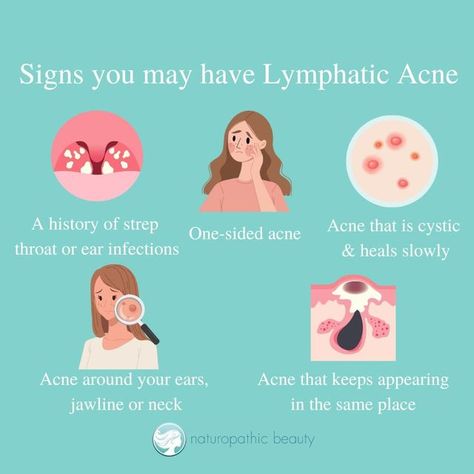 Dr. Stacey Shillington ND on Instagram: "Lymphatic acne is a type of acne that can cause discomfort and frustration for many people. It occurs when the lymphatic system, which plays a crucial role in the body's immune system, becomes congested, leading to a buildup of toxins and fluids that can cause inflammation and infection in the skin. Here are some common signs and symptoms of lymphatic acne: 👉Acne around your ears, jawline, or neck: The lymph nodes in these areas can become congested, le Acne On Neck Causes, Neck Acne Causes, Neck Acne, Skin Advice, Skin Aesthetics, Types Of Acne, Lymph Nodes, Signs And Symptoms, Holistic Healing