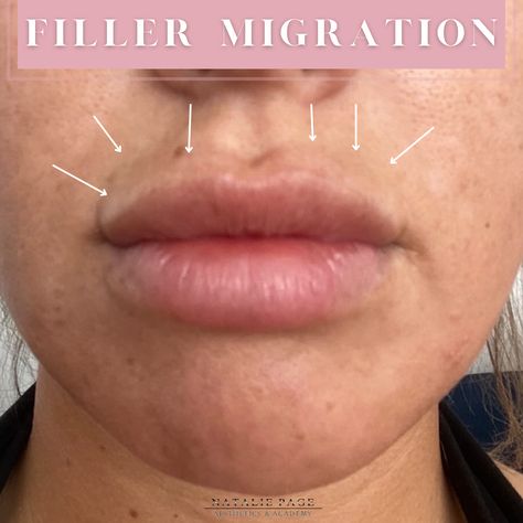 NATALIE PAGE ACADEMY EDUCATIONAL 2022 - 6 Lip Fillers Migration, Lip Filler Injection Sites, Filler Migration Lips, Migrated Lip Filler, Lip Fillers Bruising, Lips Fillers, Botox Filler, Face Fillers, Aesthetic House