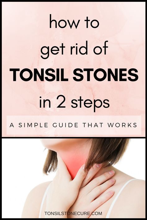 Getting rid of tonsil stones may seem like a difficult task, but it’s really not! If you're tired of dealing with tonsil stones, check out this simple, 2-step solution. Remedies For Swollen Tonsils, Tonsil Stone Removal, Swollen Tonsils, Baking Soda Benefits, Health Planner, Oral Hygiene, Dental Health, Health Remedies, Oral Care