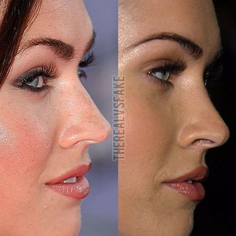 Filler Nose Job Before After, Hooked Nose Job Before And After, Nose Job Before And After Bulbous, Nose Job Tip Reduction, Megan Fox Nose Job, Nose Filler Before After Non Surgical, Nose Plastic Surgery, Jaw Reduction Surgery, Bella Hadid Nose Job Before And After