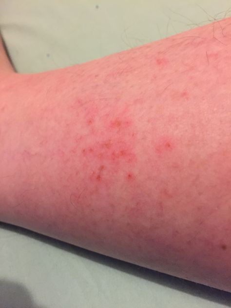 My autoimmune disease sometimes causes pinprick rashes to appear on my lower legs. The rash is hot and itchy and can develop into a larger sore (ulcer). #lupus #sores #rash Road Rash, Skin Rashes, Hashimotos Disease, Dry Skin Patches, Lower Leg, Autoimmune Disease, Skin Tips, Healthy Skin, Disease