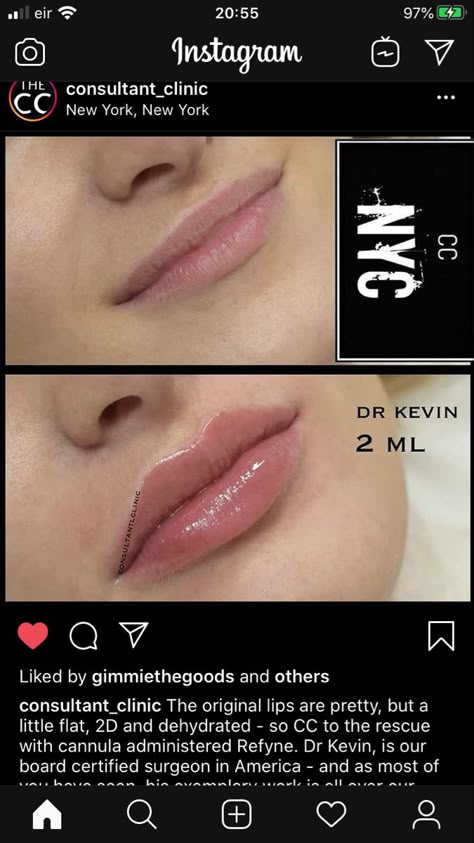 Downturned Lips Filler, Hip Filler, 1 Ml Lip Filler Before And After, Lips With Filler, Lip Filler Shape Ideas, Lip Filler Before And After, Lip Fillers Juvederm, Face Plastic Surgery, Dermal Fillers Lips