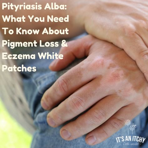 Pityriasis Alba: What You Need To Know About Pigment Loss & Eczema White Patches Pityriasis Alba, White Patches, Natural Medicine, Healthy Kids, Home Remedies, Natural Remedies, Allergies, Medicine, Need To Know