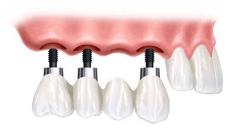 Dental Bridge Cost, Gum Surgery, Best Dental Implants, Dental Implant Surgery, Dental Implants Cost, Tooth Replacement, Emergency Dentist, Teeth Implants, Dental Bridge