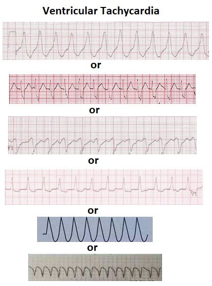 V Fib Cardiac Rhythms, Cardiology Notes, Nursing Iv, Er Tech, Medical School Interview, Ekg Interpretation, Paramedic School, Cardiac Rhythms, Med Surg Nursing