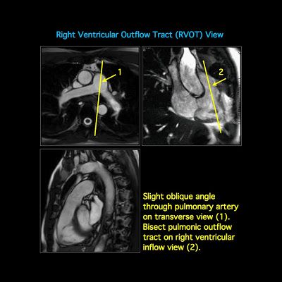 MRI BLOG: Cardiac MRI - Imaging Planes for Basic Cardiac Views Cardiac Mri Anatomy, Mri Anatomy, Cardiac Anatomy, Mri Tech, Tricuspid Valve, Mcat Prep, Mitral Valve, Cranial Nerves, Magnetic Resonance Imaging