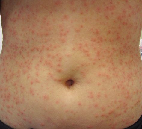 Skin Rashes Pictures, Rash Causes, Pseudomonas Aeruginosa, Itchy Rash, Summer Health, Home Remedies For Skin, Healthy Goals, Bacterial Infection, Skin Diseases