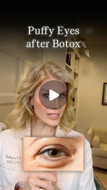 Jill Campbell - Houston Nurse Practitioner on Instagram: "▪️Puffy eyes after botox? 

▪️If you have excess loose skin under the eyes, under eye bags, malar mounds or suffer from allergies, you may be at risk for puffy eyes after Botox injections around the eyes. 

▪️Here are 2 reasons why.

1. The orbicularis oculi muscle acts like a girdle for the underlying fat pad. Weakening this muscle with botox can allow the fat pad to stick out more. 

2. The orbicularis oculi muscle helps to move our lymph fluid under the eye  as it contracts. Weakening this muscle  can allow the fluid accumulation in the eye area. 

🛟 Save this post for your reference.

👩🏼‍⚕️ Jill Campbell , FNP-C, CANS
📍 The Woodlands, TX
💻 @aestheticsjill
•
🏥 Dr.Guy Facial Plastic Surgery
☎️ (832) 956-1040 
💻  @drguyfacia Botox Under Eyes, Eye Bag Surgery, Surgery Doctor, Lymph Fluid, Hospital Health, Facial Plastic Surgery, Under Eye Puffiness, Botox Injections, Orthopedic Surgery