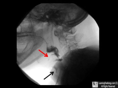 Video fluoroscopic swallowing examination (aka modified barium swallow) Modified Barium Swallow Study, Barium Swallow, Feeding Therapy, Acute Care, Best Speeches, Slp Resources, Speech Pathology, Speech Language Pathology, Sample Resume