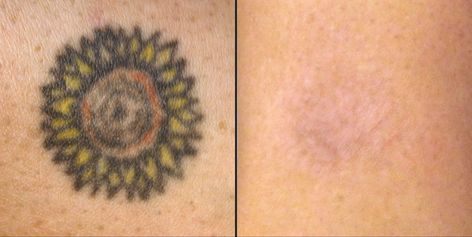 Natural Tattoo Removal: How To Remove Tattoos Naturally? #tattooremovalnatural Tattoo Eraser, At Home Tattoo Removal, Picosure Tattoo Removal, Natural Tattoo Removal, Tattoo Removal Cream, Tattoo Removal Cost, Faded Tattoo, Tattoo Diy, Tattoo Cream