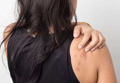 Hello, stress hives (yes, they're a thing). Here's what to do if you break out in itchy bumps at the worst possible time. Hives Causes, Chest Discomfort, Heart Muscle, Cleveland Clinic, Family Medicine, Heart Problems, Chest Pain, Stressful Situations, Health Inspiration