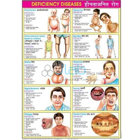 Deficiency Diseases Chart India, Deficiency Diseases Chart Manufacturer, Deficiency Diseases Chart Suppliers and Deficiency Diseases Chart Exporter in India Vitamin Deficiency Chart, Vitamin Chart In Hindi, Deficiency Diseases Chart, Vitamin Deficiency Diseases Chart, Communicable Diseases, Prevention Of Communicable Diseases Poster, Deficiency Diseases, Ambala Cantt, Uganda Kampala