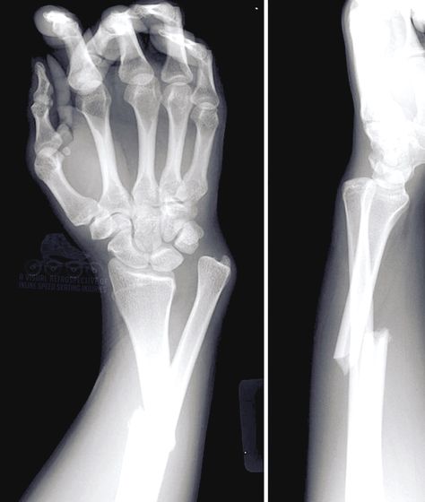 I'm one of the lucky ones that have broken a bone in their body, and i really hope I don't break a bone in the future! Fractured Arm, Dupuytren's Contracture, Radiology Technologist, Bone Fracture, Broken Arm, Hand Therapy, 웃긴 사진, Anatomy And Physiology, Radiology