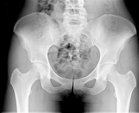 Vitamins B-6 and B-12 linked with increased risk of hip fracture Human Joints, Hip Fracture, Bone Loss, Higher Dose, B 12, Hip Pain, Muscle Tone, Intelligent Design, Signs And Symptoms