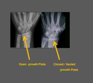 When and why the growth/ epiphyseal plates close – GTWSL Epiphyseal Plate, Height Exercise, Increase Height Exercise, Estrogen Hormone, Height Growth, Pituitary Gland, Plant Tissue, Height Increase, Animal Study