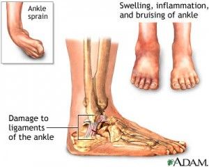 Linear comparison of two strains with drawn shaded connections Ankle Ligaments, Ankle Fracture, Twisted Ankle, Calf Cramps, Male Perspective, Ligament Tear, Fitness Shoes, Ankle Pain, Leg Cramps