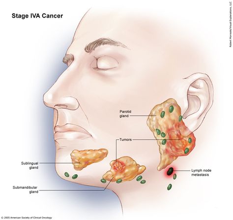 Parotid Gland Swelling, Salivary Gland Infection, Swimmers Ear Remedy, Swelling Remedies, Parotid Gland, Human Body Organs, Goo Hara, Facial Nerve, Salivary Gland