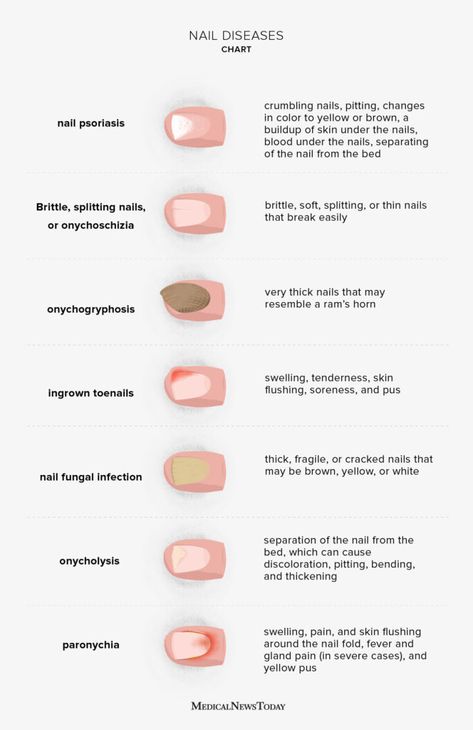 Nail diseases chart: Pictures, symptoms, and treatments Nail Disorders, Nail Tech School, Nail Conditions, Nail Problems, Health Chart, Nail Infection, Nail Courses, Holistic Diet, Brown Spots On Face