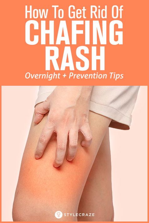 How To Get Rid Of Chafing Rashes Overnight + Prevention Tips #homeremedies #remedy #remedies Chafed Skin Remedy, Chafing Remedy Thighs, Chafing Remedies, Inner Thigh Rash, Skin Rash Remedies, Heat Rash Remedy, Home Remedies For Rashes, Common Skin Rashes, Home Remedies For Face