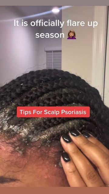 Scaly Scalp Remedies, Scalp Psiorasis, Dry Patches On Scalp, Scalp Inflammation Remedies, Psoriatic Scalp Remedies, Scalp Psorasischic, Scalp Psorasischic Remedies, Psoriatic Skin Remedies, Psoriatic Scalp