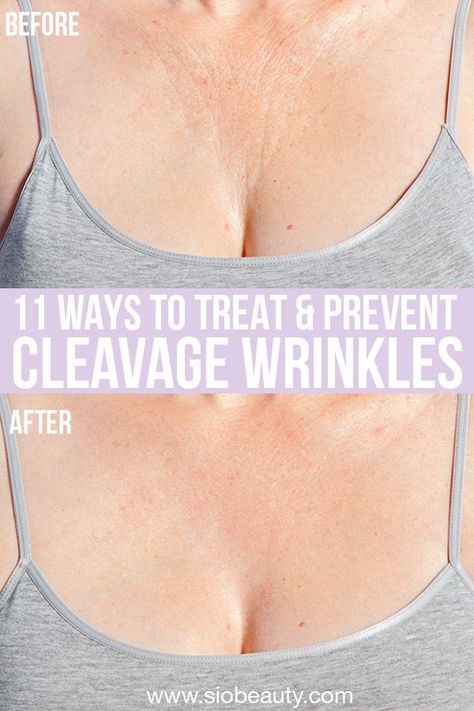 The ultimate guide to treating and preventing chest wrinkles. We've cover all the options that you have to improve the appearance of the delicate skin on your cleavage for a more radiant and youthful look. These are great remedies for creases on your cleavage caused by sun damage, side sleeping and natural aging. From natural skincare remedies to surgical procedures. #siobeauty #antiaging #antiwrinkles #decollete #skinrejuvenation #lookyounger #chestwrinkles Chest Wrinkles Remedies Diy, How To Get Rid Of Chest Wrinkles, Neck And Chest Skin Care, Crepey Neck Skin Remedies Diy, Chest Wrinkles Remedies, Neck Creases How To Get Rid Of, Neck And Decollete Care, Crepey Skin Remedies Diy, How To Tighten Neck Skin